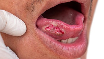 Oral cancer lesion