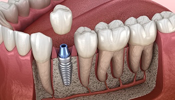 3D image of dental implant