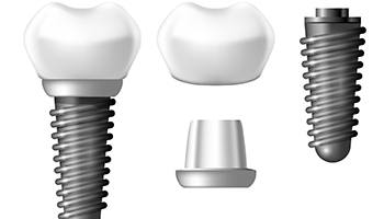 Illustration of a dental implant split into its different components