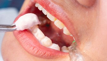 Closeup of fluoride foam being applied to someone’s teeth