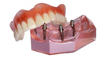 Model of All-on-4 dentures