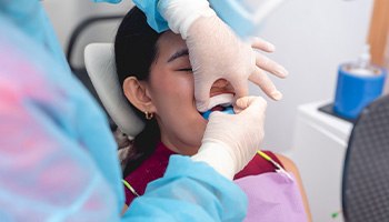 Gloved hands placing fluoride trays over girl’s teeth