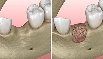 model of the jaw before and after bone grafting in Eatontown 