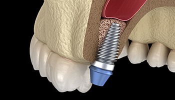 model of how a sinus lift in Eatontown works 