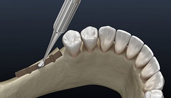 model of a ridge expansion procedure 