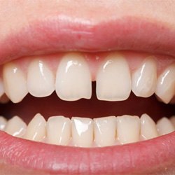 Person’s smile with gap between the front teeth 