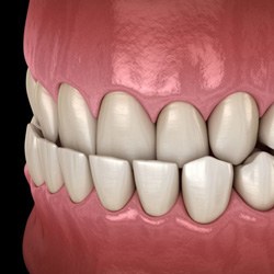   Illustration of an underbite against dark background