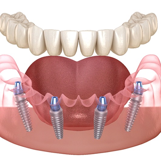 Illustration of All-on-4 in Eatontown, NJ for lower arch