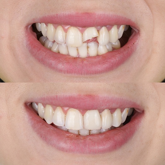 Dental bonding is ideal for patients with minor chips, gaps, or stains on their teeth