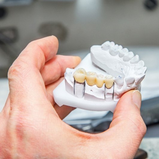 Dental bridge in Eatontown on clay model