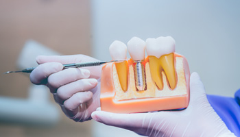 Dentist pointing to model of dental implant
