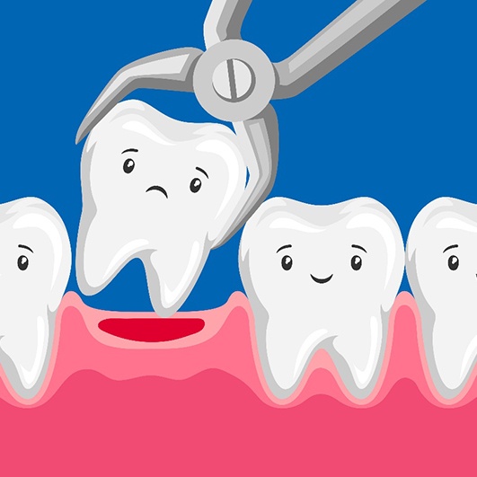 Illustration of a tooth extraction