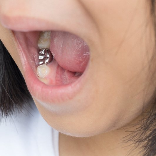 Child with a dental crown