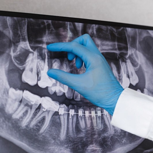 An X-ray image of wisdom teeth before a tooth extraction in Eatontown, NJ