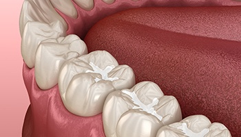 Digital illustration of tooth-colored fillings in Eatontown 