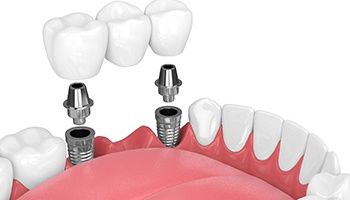 Dental bridge being anchored to a pair of implants