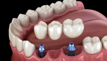 Animated dental implant supported fixed bridge placement