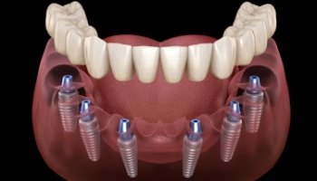 Animated dental implant supported dentures placement