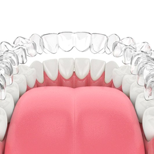 Illustration of Nu Smile Aligners in Staten Island on lower dental arch
