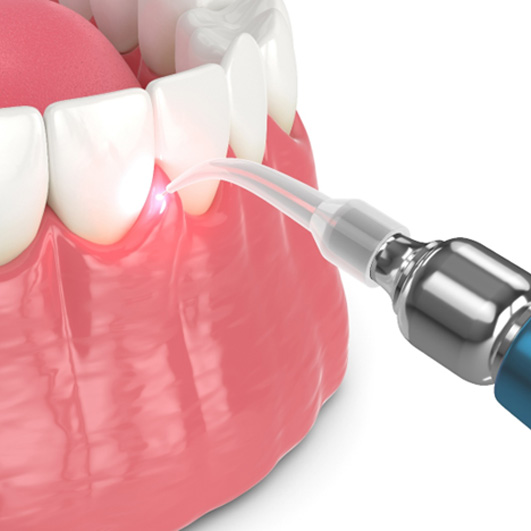 Illustration of gum recontouring in Eatontown, NJ performed with a laser