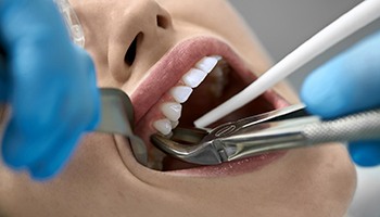 tooth extraction root canal therapy in Eatontown 
