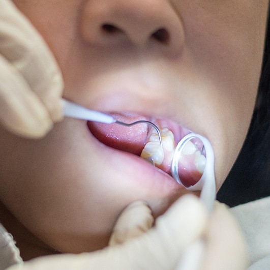 A child getting a dental sealant