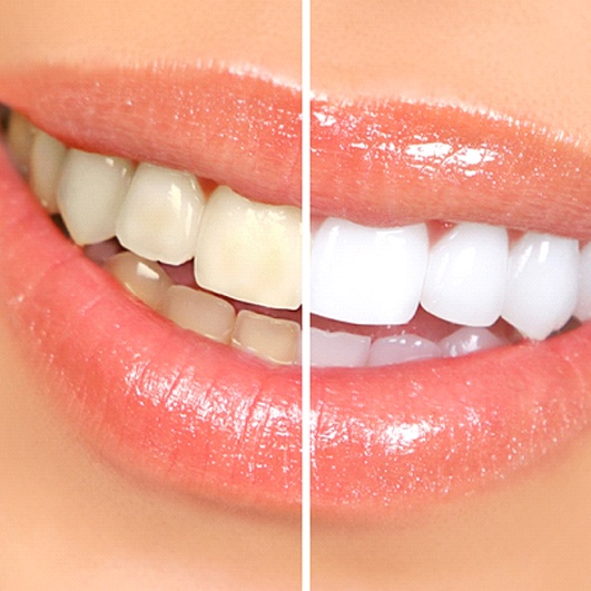 Closeup of woman's teeth before and after teeth whitening treatment