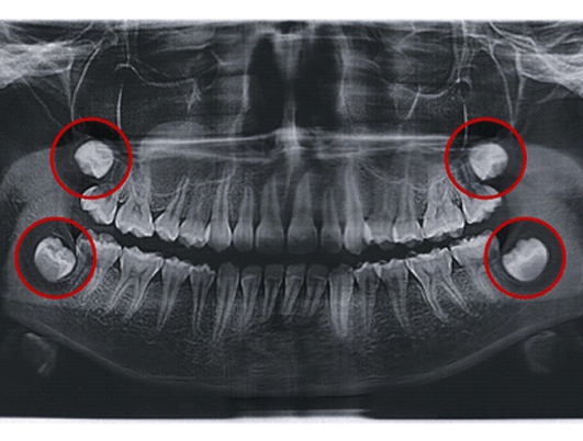 an X-ray of wisdom teeth in Eatontown
