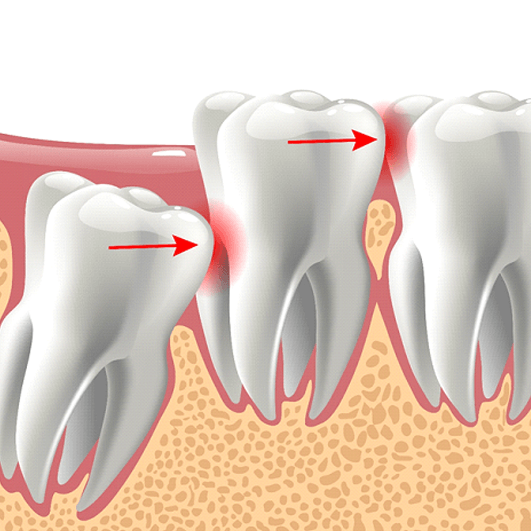 an illustration of an impacted wisdom tooth in Eatontown