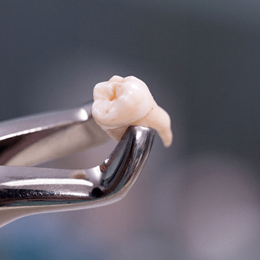 a wisdom tooth held by special forceps