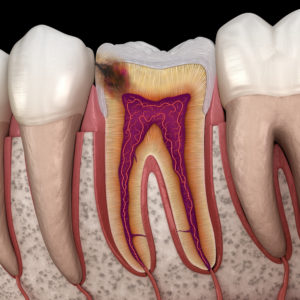 Hidden cavity between two molar teeth on black background
