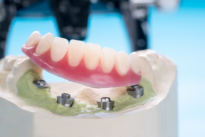 Denture resting on top of dental implants in a wax model